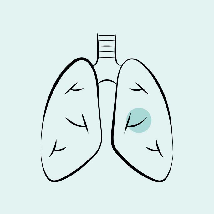icon11-lung-symptoms