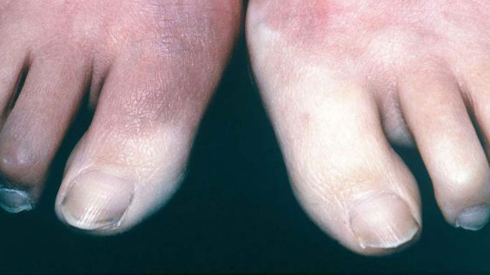 Raynaud’s phenomenon