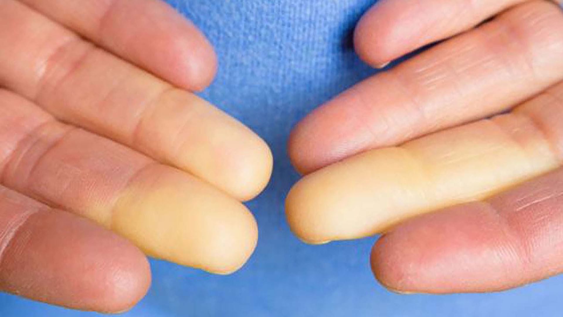symptoms-hands_raynauds_phenomenon_hands_0