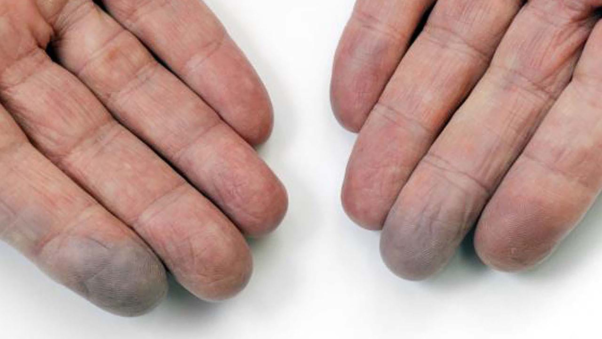 symptoms-raynaud_s_disease-spl