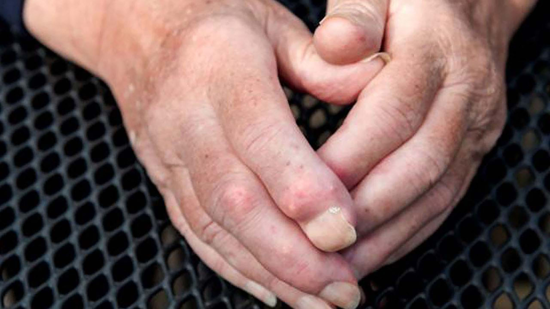 symptoms-skin_hard_lumps_calcinosis1